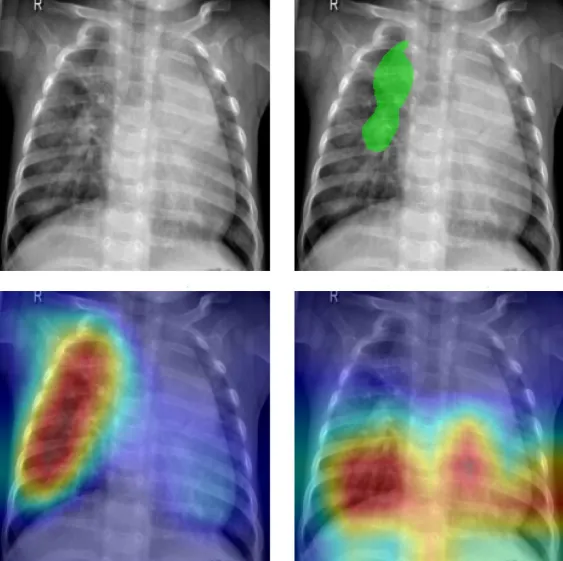 Thumbnail for Do AI and Human Experts See Pneumonia the Same Way?